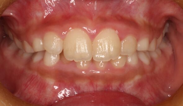 下の前歯のガタつきが気になる