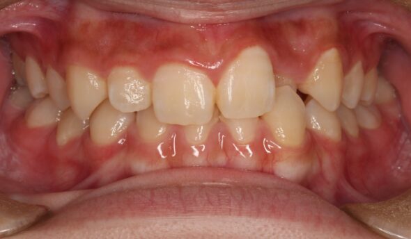 上の歯が1本だけ奥に引っ込んでいることが気になる