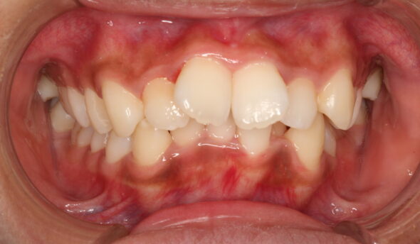 全体的な歯のがたつきが気になる