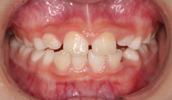 上の前歯が捻じれていることが気になる