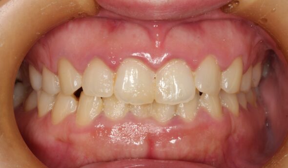 上下前歯のがたつきが気になる