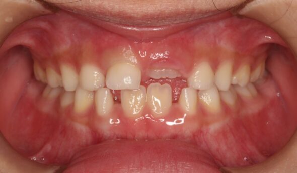 下の前歯が後ろから生えてきた