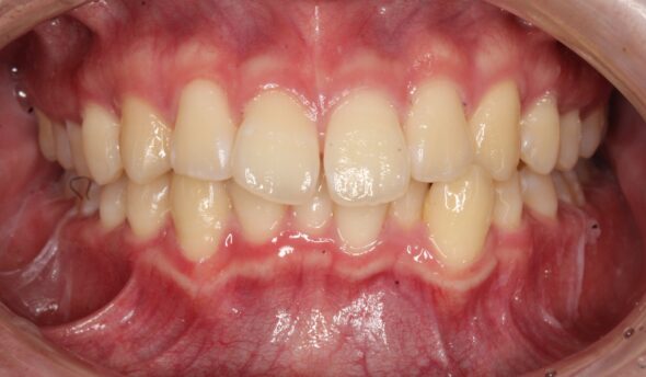 上下の前歯のがたつきが気になる