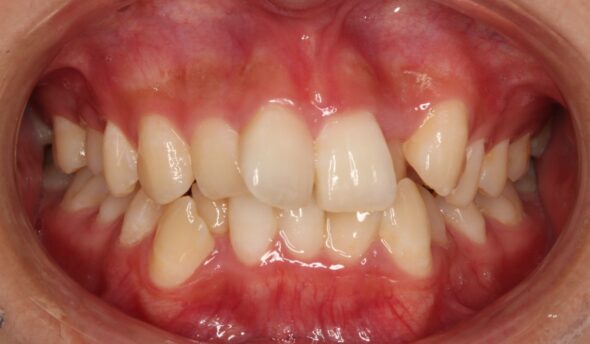 上下のがたつきが気になる