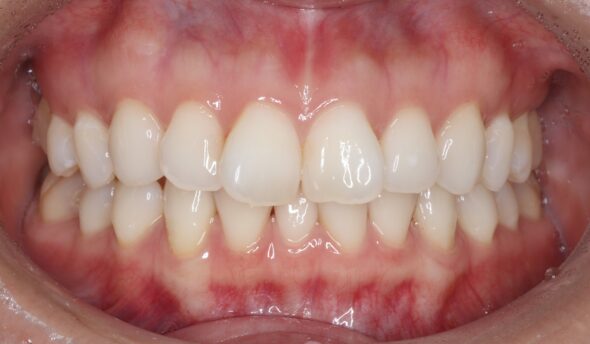 上下の前歯のがたつき、捻じれが気になる