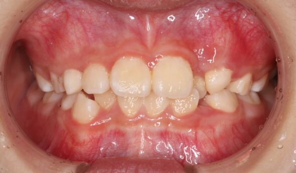 全体的な歯並びのがたつきが気になる