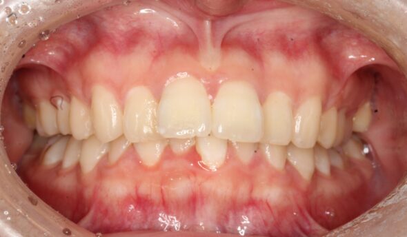 上顎前歯部の突出感が気になる