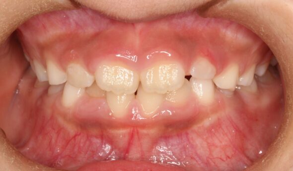 上下の叢生が気になる