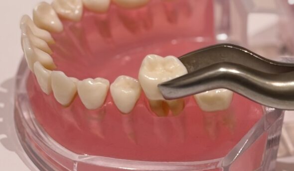 インビザラインの抜歯が埋まるまでの期間は？隙間が目立つ場合の対処法も紹介